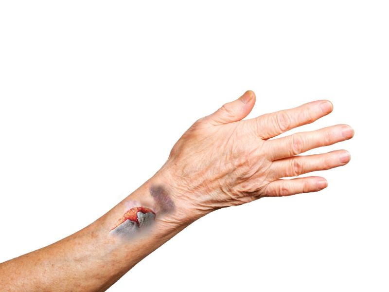 Skin tears in older adults Nursing care